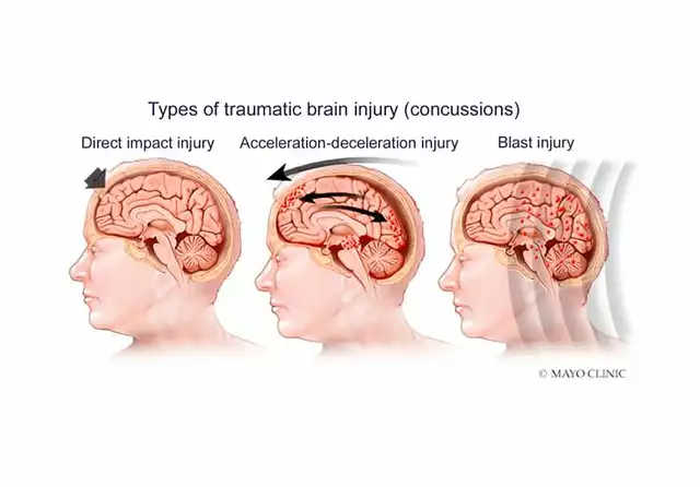 How Myosis Can Be an Indicator of Brain Injury