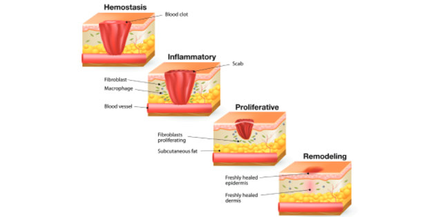 The Importance of Calcitriol in Wound Healing and Tissue Repair